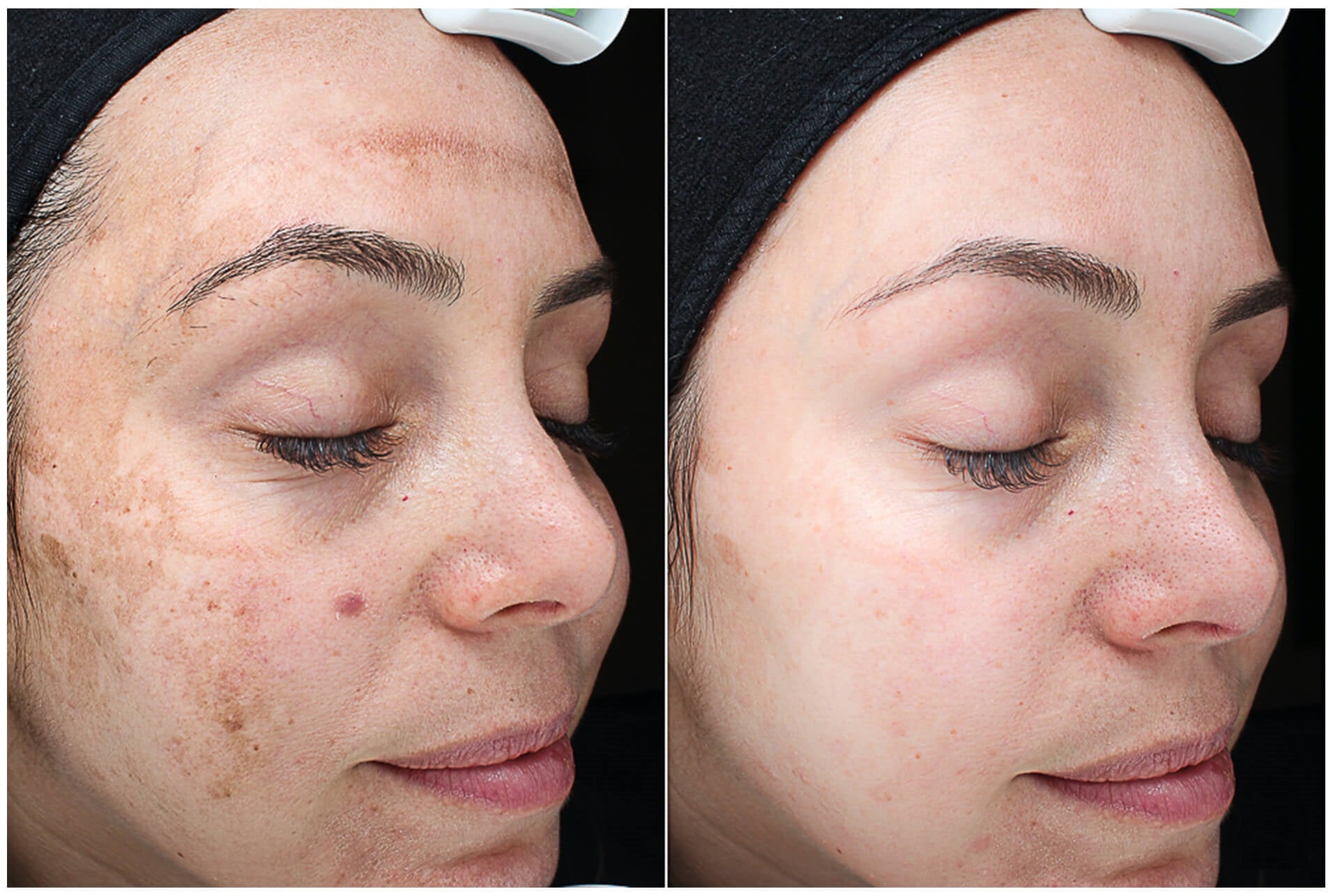MELASMA REDUCTION THERAPY