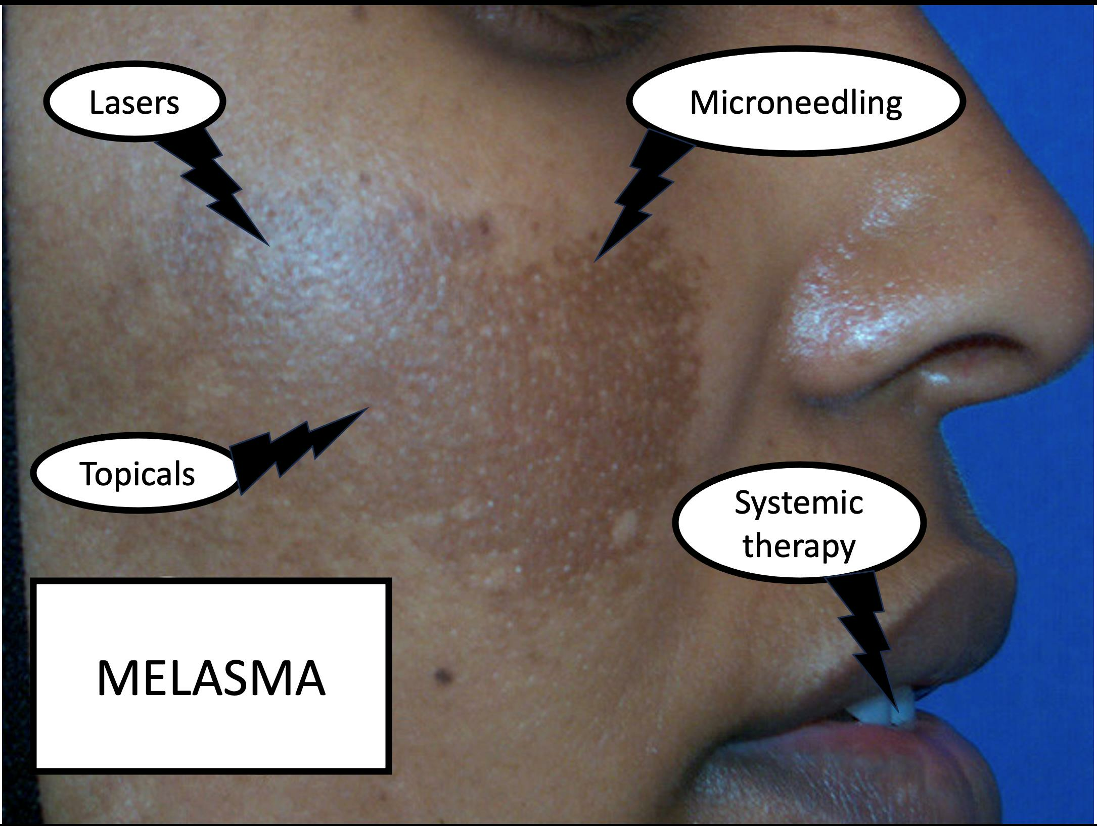 MELASMA REDUCTION THERAPY