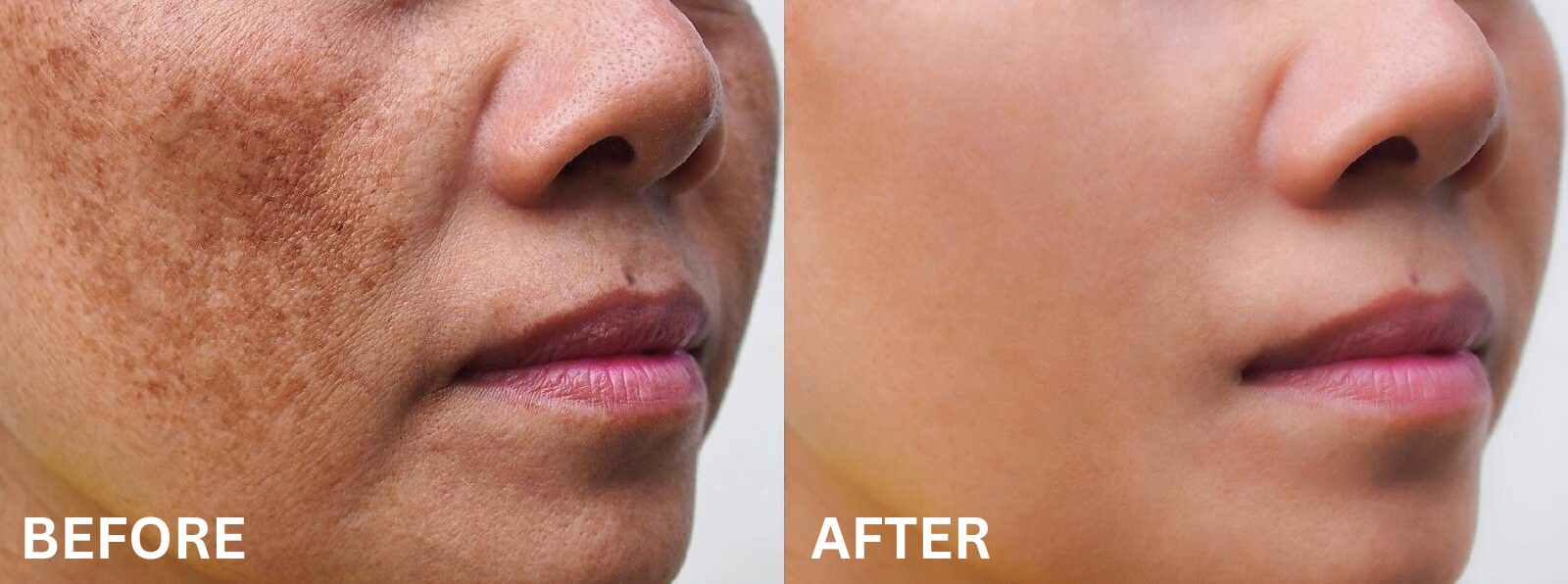MELASMA REDUCTION THERAPY