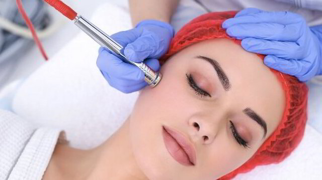 MICRODERMABRASION (MDA) THERAPY