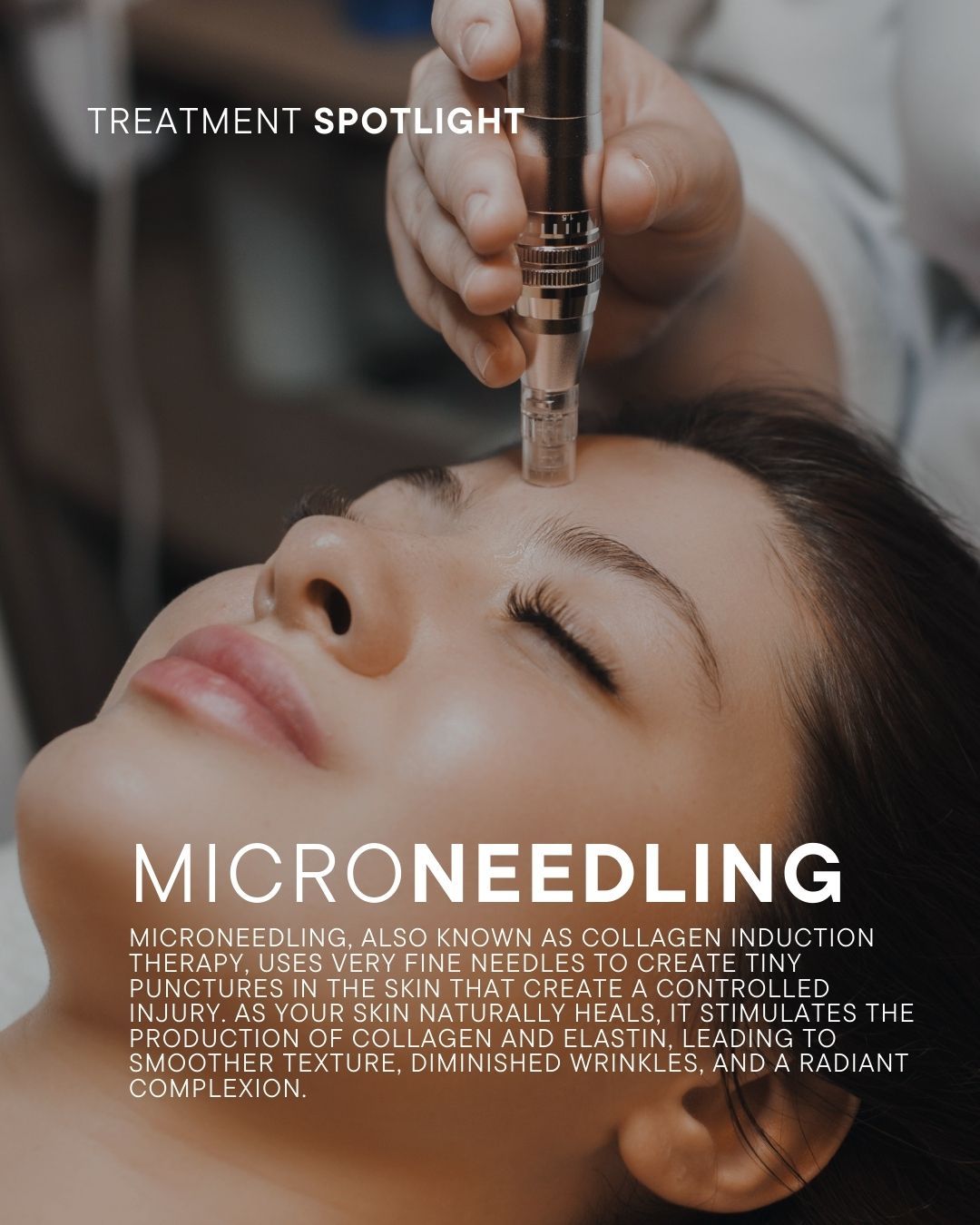 MICRONEEDLING THERAPY