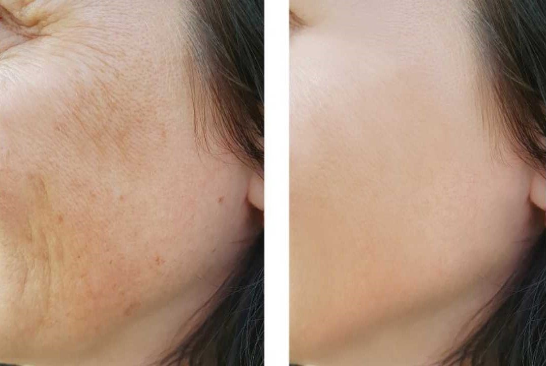 NANO NEEDLING THERAPY