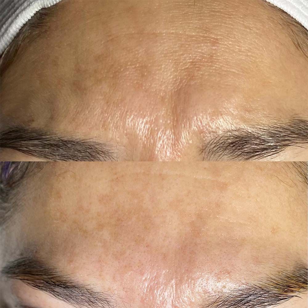 NANO NEEDLING THERAPY