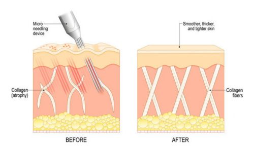 NANO NEEDLING THERAPY