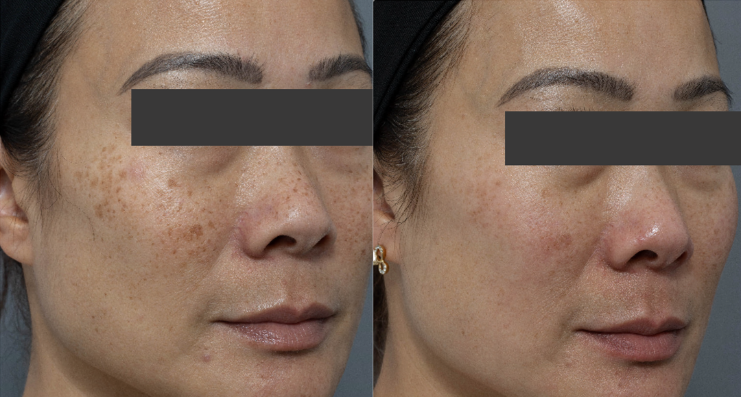 FRECKLES REDUCTION THERAPY