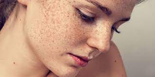 FRECKLES REDUCTION THERAPY