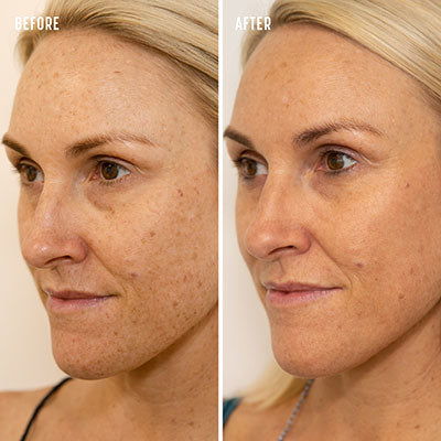 FRECKLES REDUCTION THERAPY
