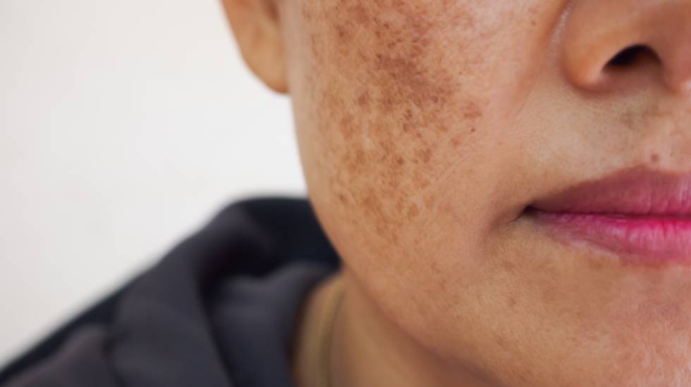 FRECKLES REDUCTION THERAPY