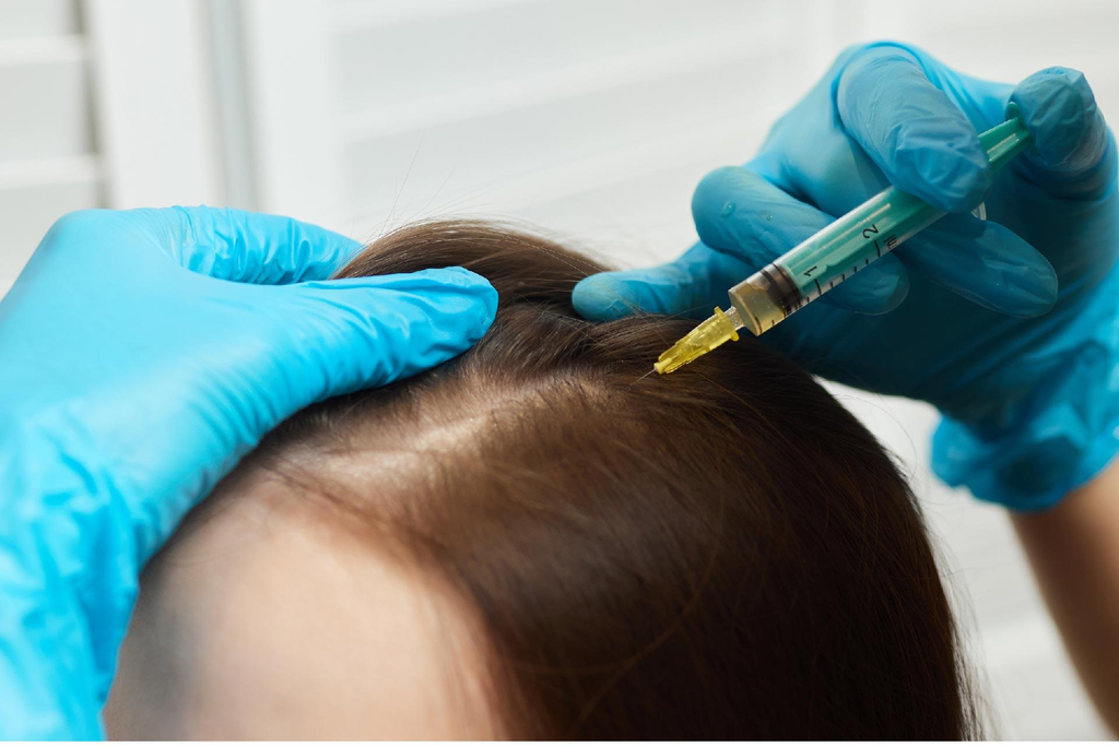 SCALP PRP THERAPY