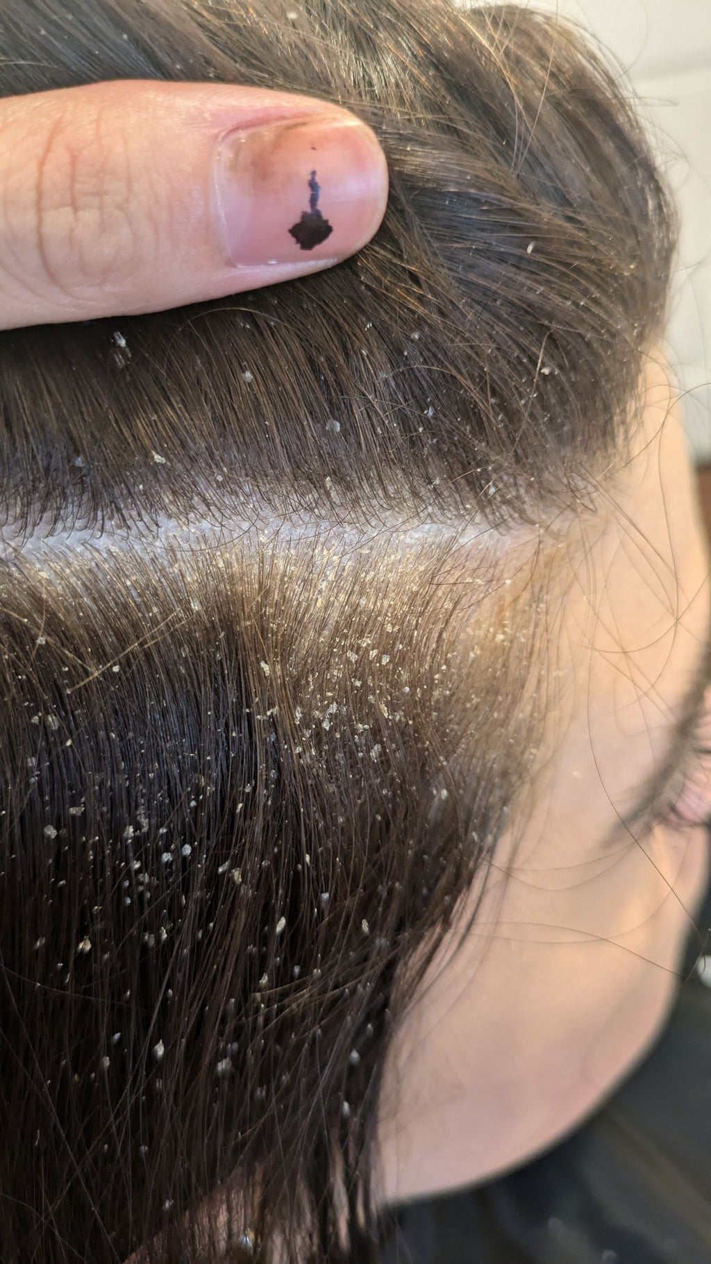 SCALPURE (dandruff removal therapy)