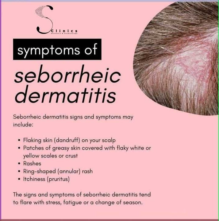 SEBORRHEIC DERMATITIS THERAPY