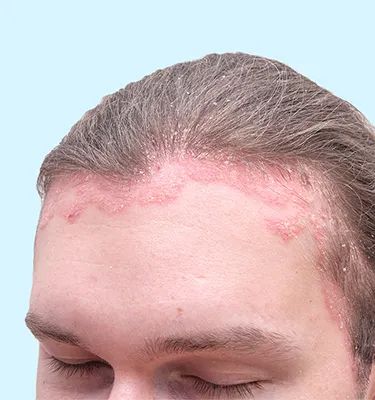 SEBORRHEIC DERMATITIS THERAPY